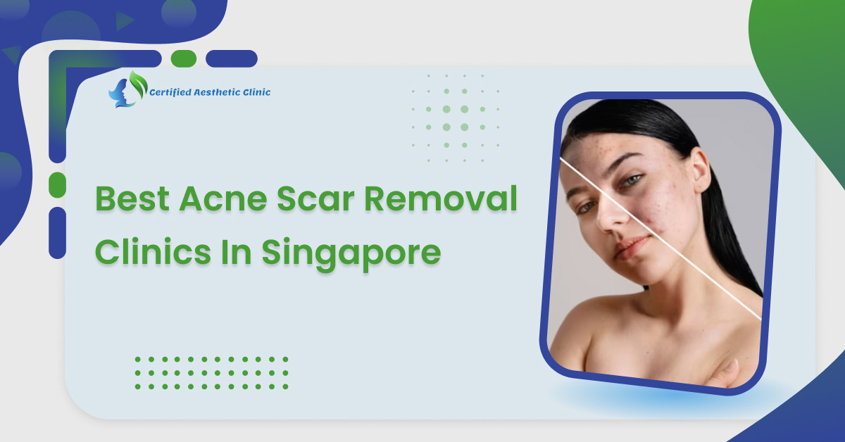 Best Acne Scar Removal Clinics In Singapore