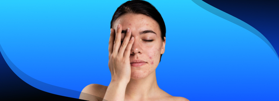 Acne Treatment in Singapore